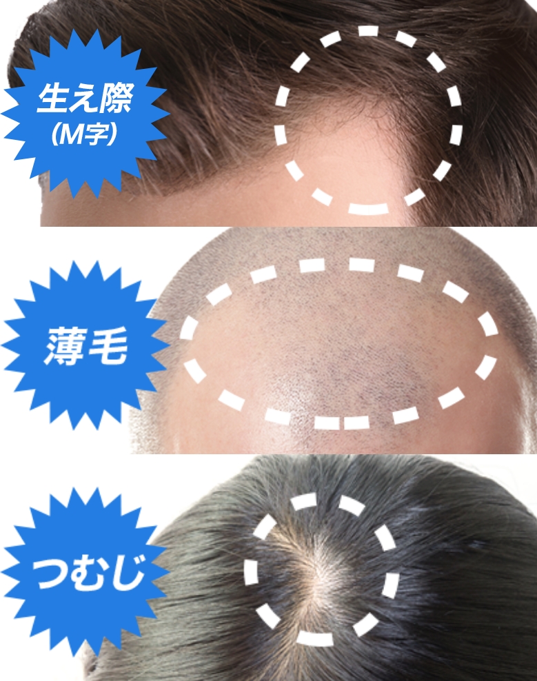 手軽に始める薄毛治療！